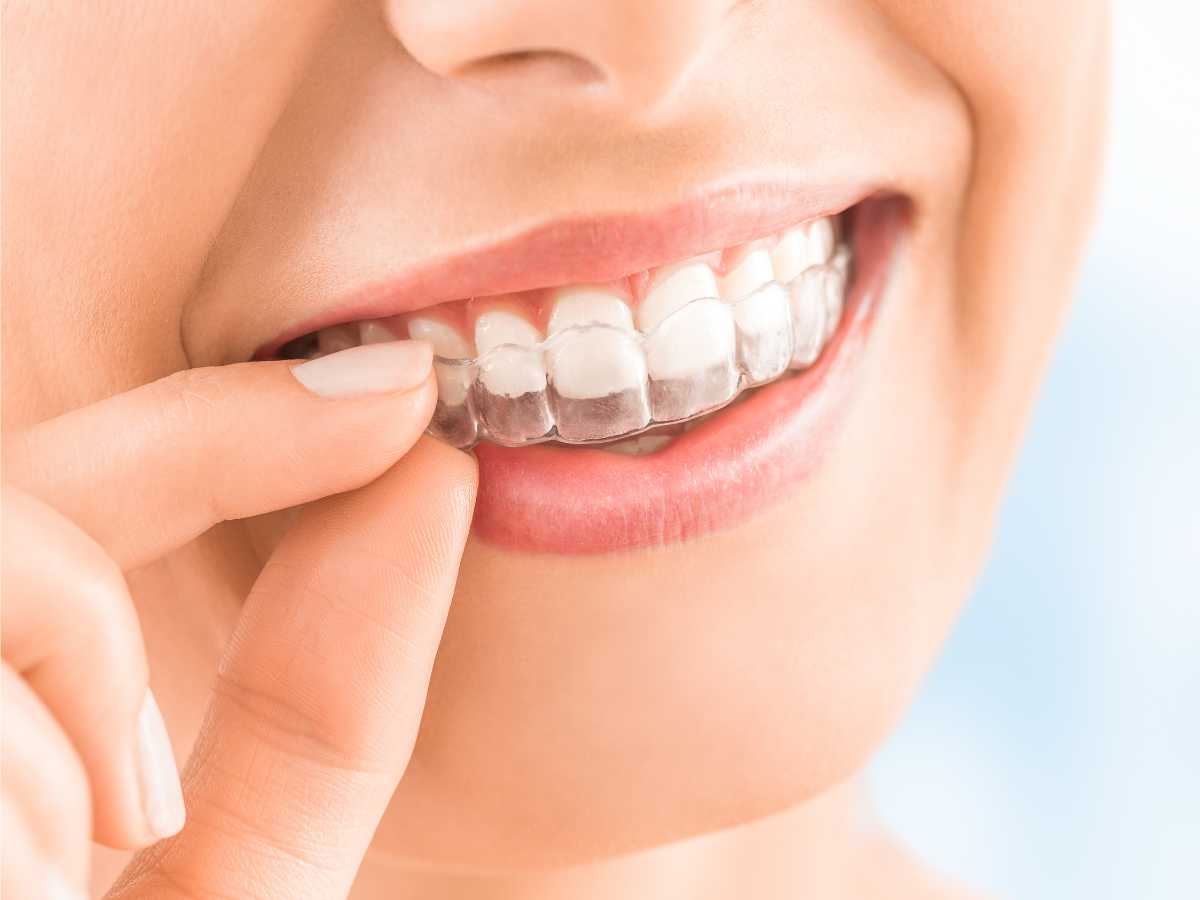 Woman smiling placing clear dental aligner.