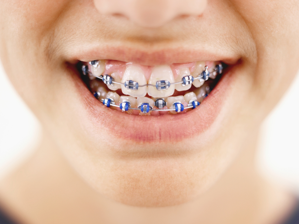 Teen smile with braces.
